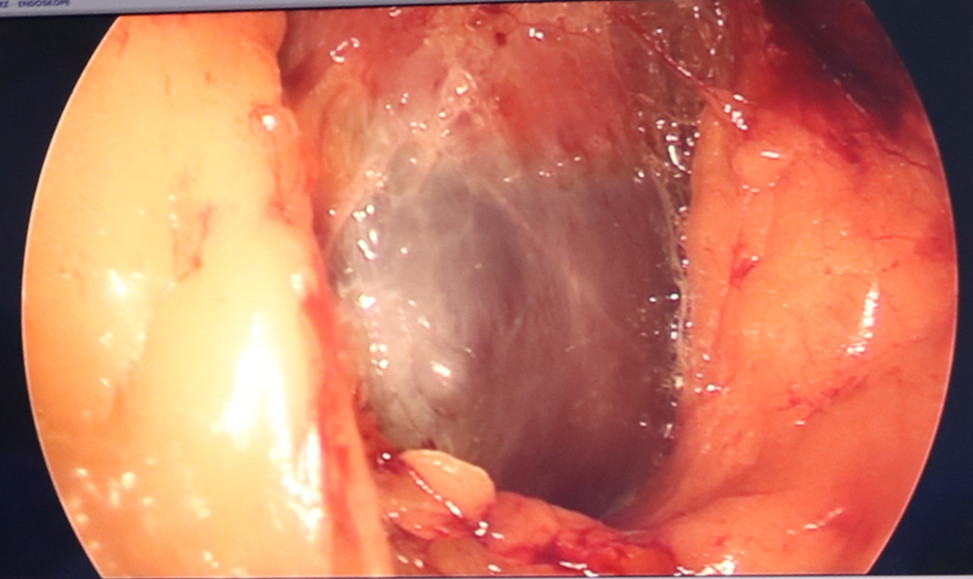 体检发现肾囊肿,芝罘医院成功微创治疗